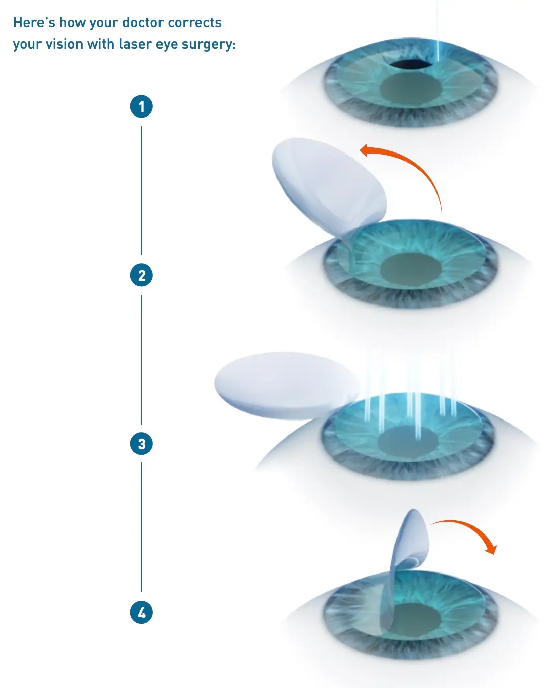Diagram explaining how LASIK works